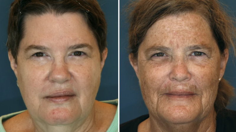 Premature Ageing Case Study in Twins: How Lifestyle Choices Shape Skin Health